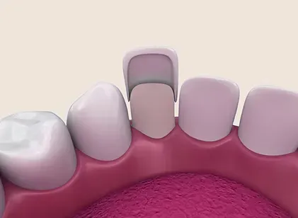 Illustration of a porcelain veneer being placed over a front tooth