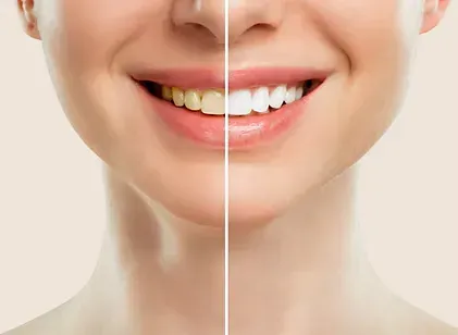Before-and-after comparison of a smile after professional teeth whitening