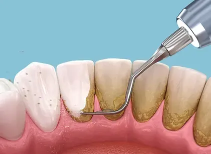Illustration of a scaler removing tartar below the gumline during a deep cleaning