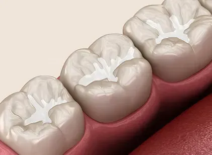 Illustration of dental sealants on the chewing surfaces of molars