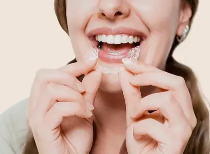 Woman fitting a clear custom retainer over her teeth