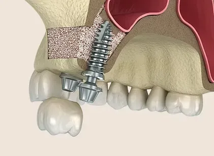 Illustration of a bone graft supporting a dental implant in the upper jaw