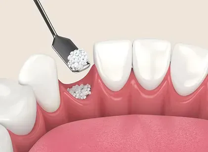 Illustration of bone graft material placed in an empty tooth socket