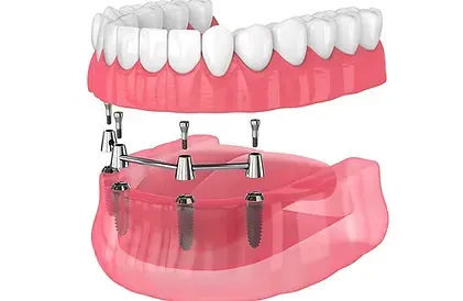 Illustration of a denture that snaps onto a bar attached to dental implants