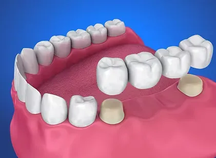 Illustration of a dental bridge replacing a missing tooth