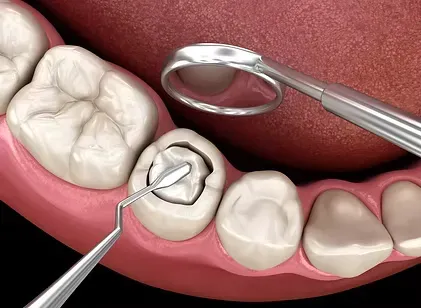 Illustration of a tooth-colored filling placed in a molar