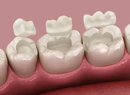 Illustration of ceramic inlays and onlays fitted to molars