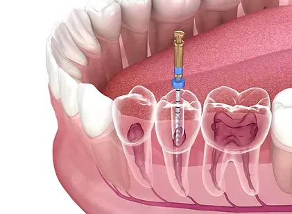 Illustration of a root canal file cleaning the canals of a molar