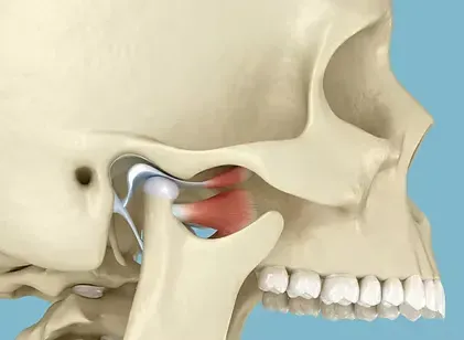 Illustration of the temporomandibular joint (TMJ) where the jaw meets the skull