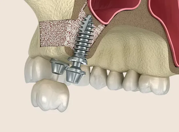 Illustration of a bone graft supporting a dental implant in the upper jaw