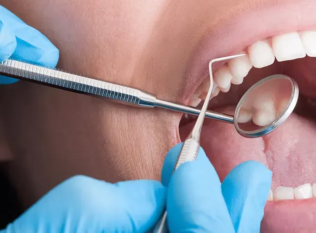 Dentist examining a patient's teeth with a mouth mirror during a dental exam