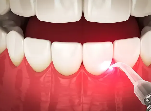 Illustration of laser gum disease treatment along the gumline