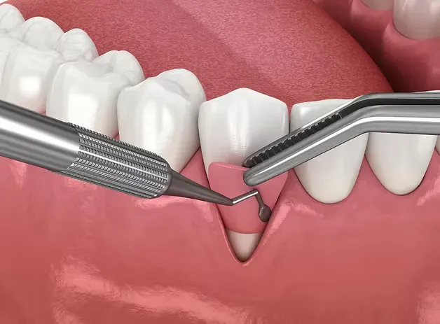 Illustration of gum grafting to cover a receding gumline