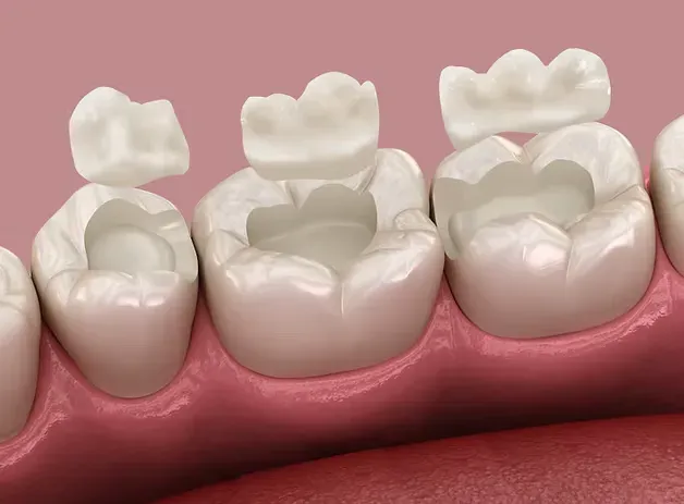 Illustration of ceramic inlays and onlays fitted to molars