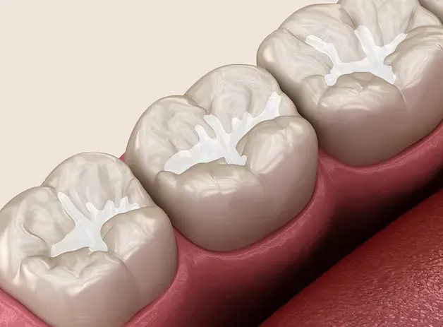 Illustration of dental sealants on the chewing surfaces of molars
