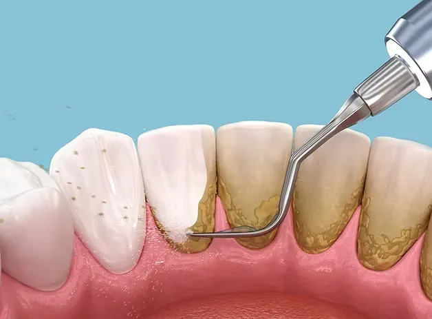 Illustration of a scaler removing tartar below the gumline during a deep cleaning